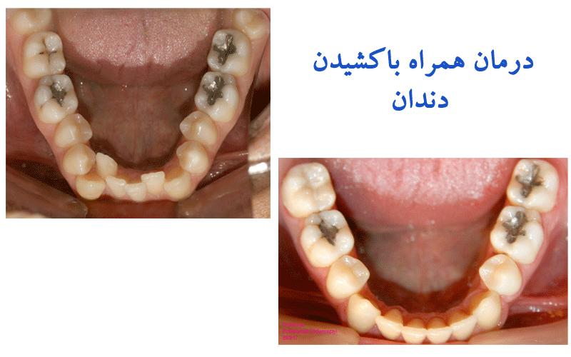 درمانهاي همر اه با كشيدن دندان 