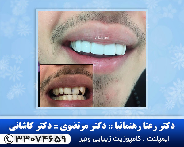 کامپوزیت 